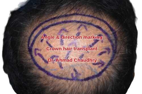 Hair restoration crown area preparation