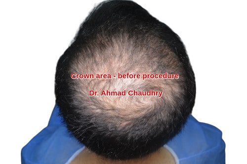 Hair transplant Islamabad patient