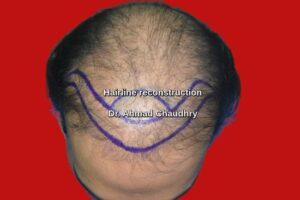 Hairline repair Bahawalpur patient