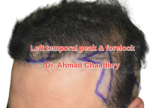 Left temporal peak hair restoration