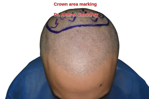 Marking before Fue hair restoration procedure