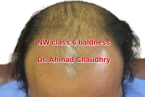Norwood class six baldness pattern
