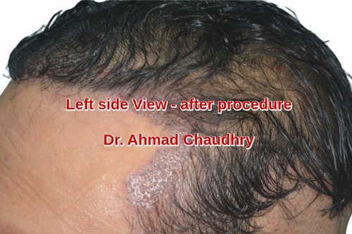 Temporal peak hair restoration procedure