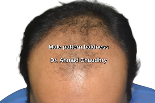 Baldness cantt Lahore patient