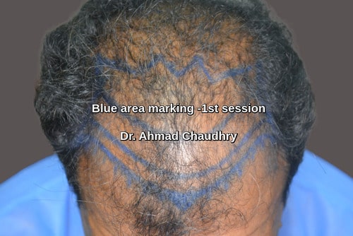 Baldness treatment area Malaysia patient