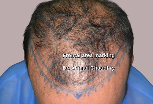 Baldness treatment marking area