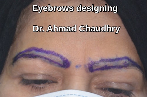 Eyebrows hair restoration Pakistan