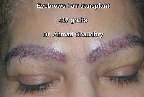 Female eyebrows reconstruction Pakistan