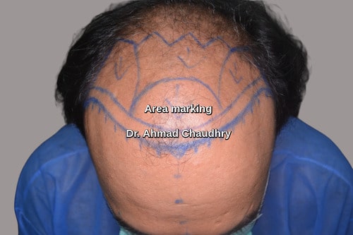 Frontal head hair restoration UK patient