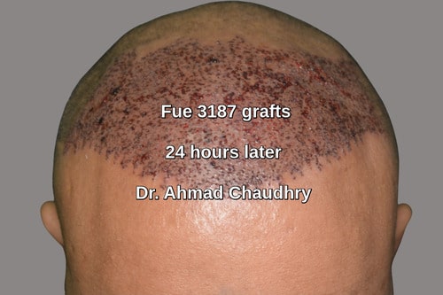 Fue 3187 grafts after one day