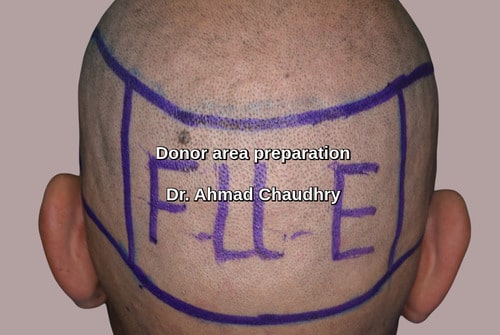 Fue donor area Afghanistan patient