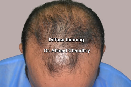 Hair transplant Kabul Afghanistan patient | 3000 grafts abroad Free quote