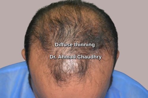 Hair transplant Kabul patient