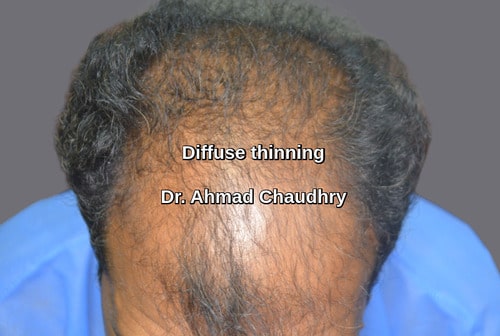 Hair transplant Kuala Lumpur