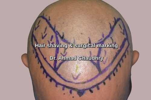 Shaving before fue procedure