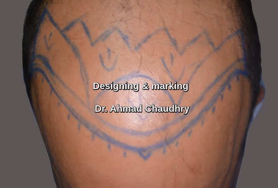 Bald area marking designing