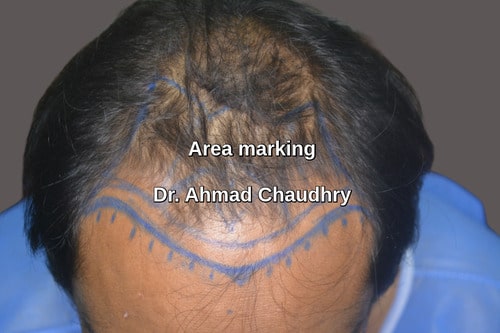 Front hair loss area marking