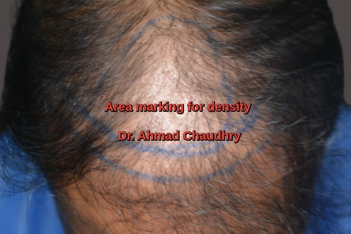 Fue hair restoration DHA Lahore