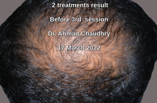 Hair regeneration therapy clinic results