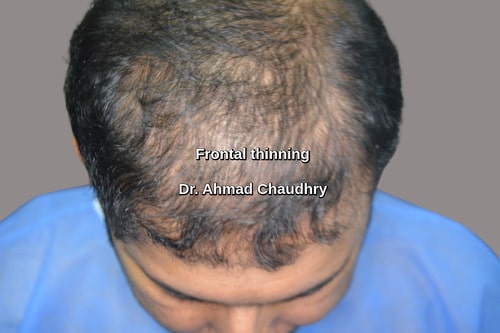 Hair transplant Al Ahsa Saudi Arabia