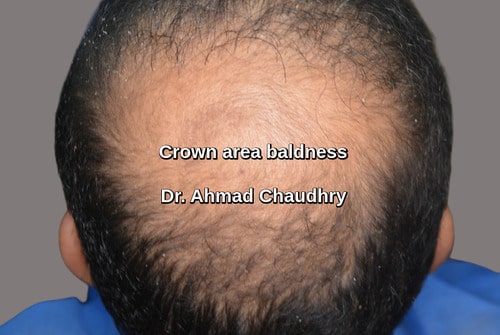 Hair transplant Dubai patient