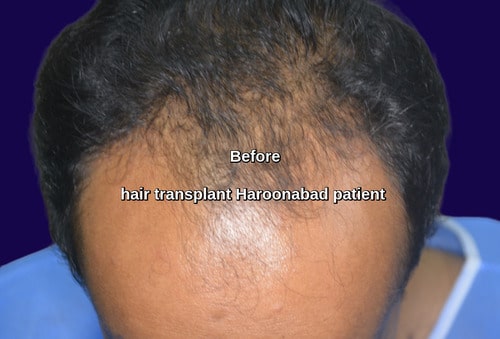 Hair transplant Haroonabad patient