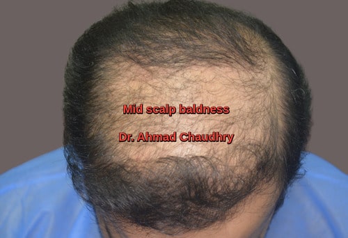 Hair transplant Hertfordshire patient