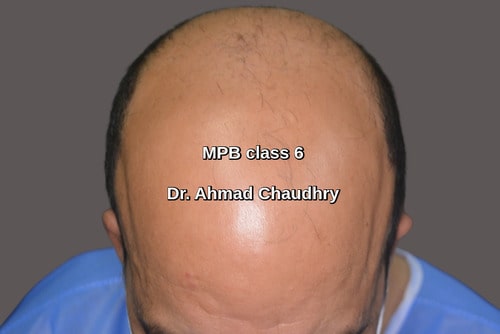 Hair transplant Malaysia patient
