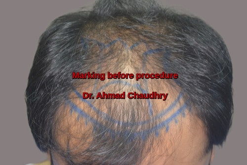 Hair transplant Nawab Town Lahore
