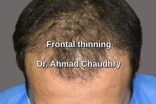 Hair transplant Shadbagh Lahore patient