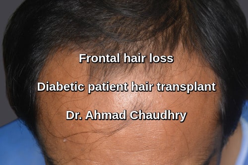 Hair transplant wapda town patient