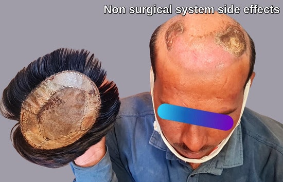 Non surgical hair replacement system side effect