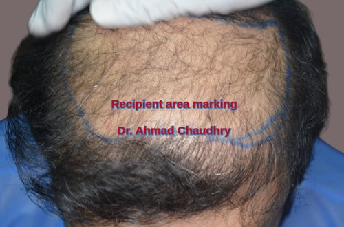 Recipient area marking before procedure