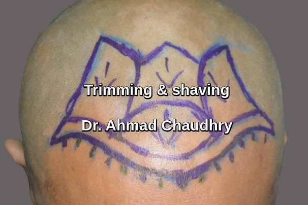 Shave marking before Fue