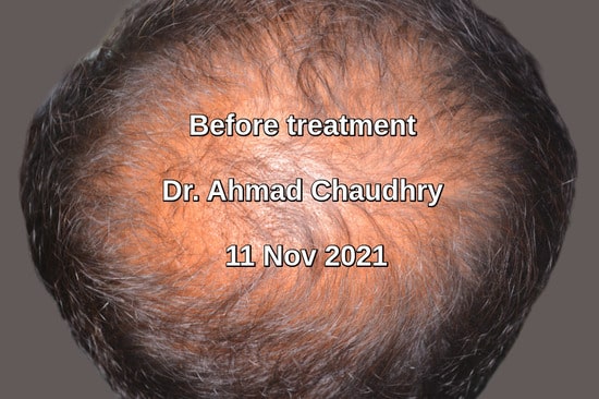 Stem cell hair loss -Baldness treatment Lahore Pakistan