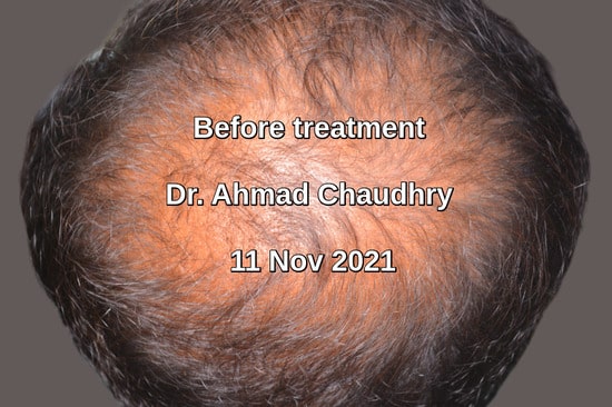 Stem cell hair loss treatment Lahore Pakistan