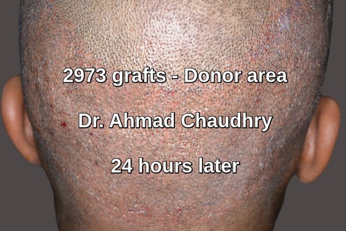 2973 grafts donor area healing