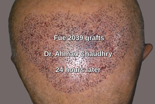 3130 hairs mid scalp hair restoration Canada patient