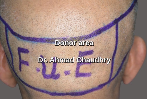 Fue donor area marking Windsor patient