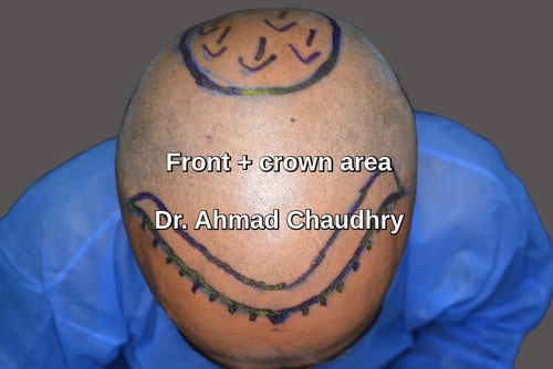 Hair restoration patient front and crown area