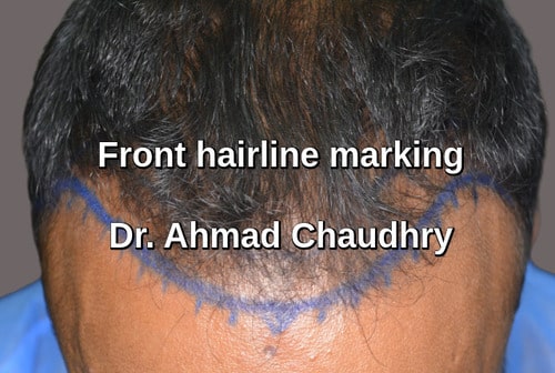 Hair transplant Green town Lahore