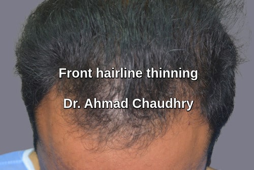 Hair transplant Madrid Spain