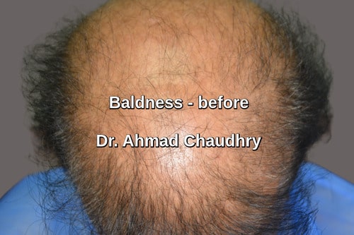 Hair transplant Windsor Canada