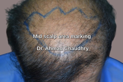 Mid scalp area marking