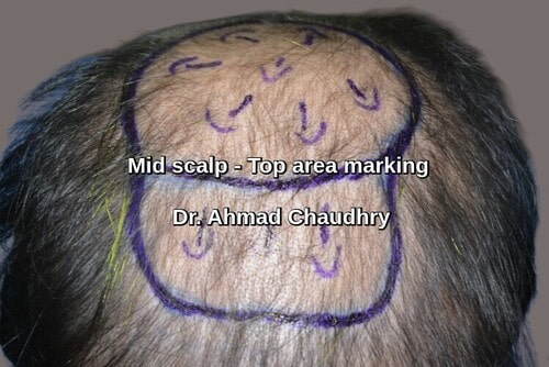 Fue hair restoration Garden town Lahore patient