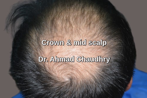 Hair transplant Garden town Lahore