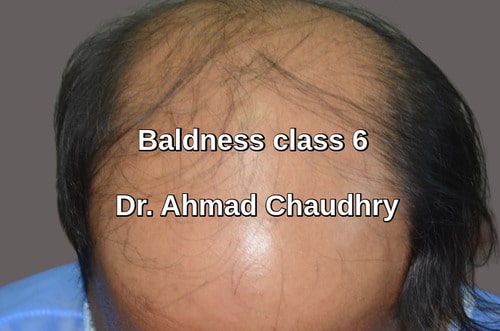 Hair transplant Sahiwal