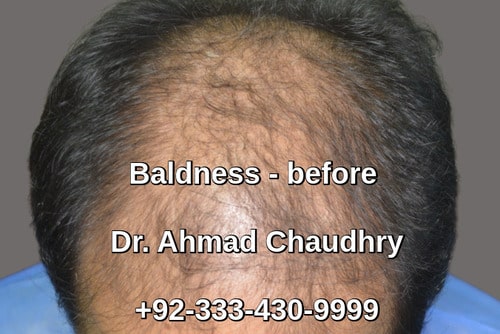 Hair transplant gulberg 5 Lahore