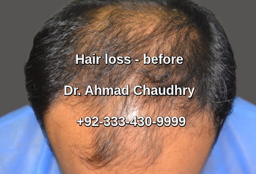 Hair transplant renala khurd okara