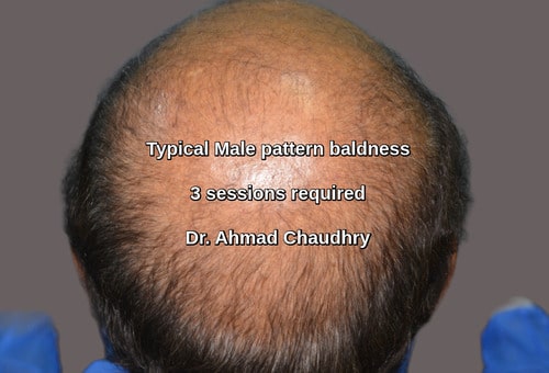 Baldness treatment Salisbury patient abroad